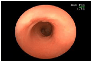 内視鏡の画像　大腸