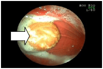 胃の中の種を取り出した例