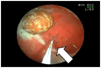 胃の中の種を取り出した例