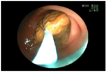 胃の中の種を取り出した例