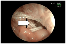 胃の中のヒモを取り出した例