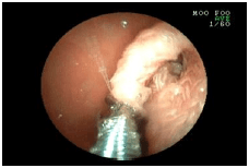 胃の中のヒモを取り出した例