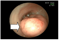 胃のポリープを採ってきた例