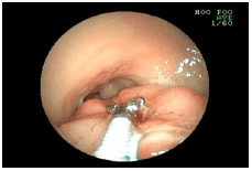 胃のポリープを採ってきた例