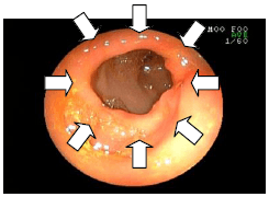 胃のしこりを調べた例