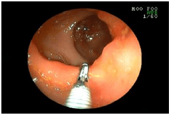 胃のしこりを調べた例