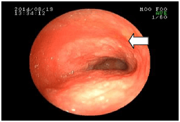 小腸の炎症を調べた例