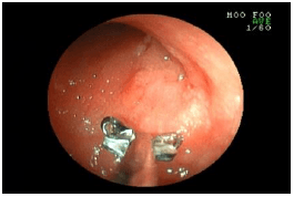 小腸の炎症を調べた例