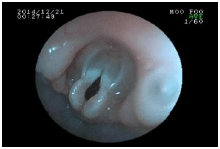 内視鏡を使った呼吸器の検査　気管の入り口