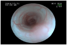 内視鏡を使った呼吸器の検査　気管の中