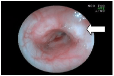 内視鏡を使った呼吸器の検査　気管内のできもの（矢印）