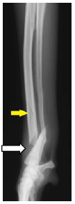 ボルゾイの前足の骨折（橈尺骨骨折）　手術前